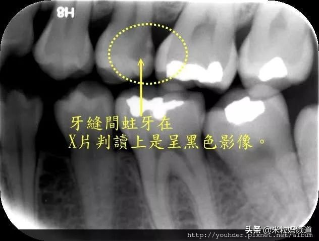 小朋友的蛀牙是怎么形成的,10岁小孩有7颗蛀牙