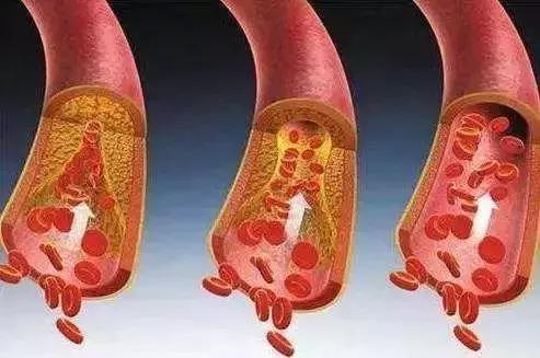 血栓栓住腿部怎么痊愈,血栓栓住胳膊怎么好得快