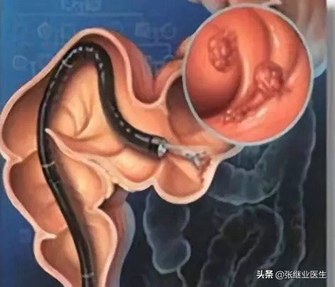 重视便血的早期诊疗,便血一定要重视吗