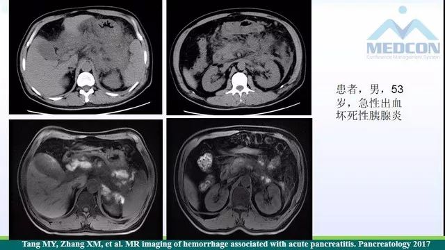急性胰腺炎的护理措施,急性胰腺炎影像与临床