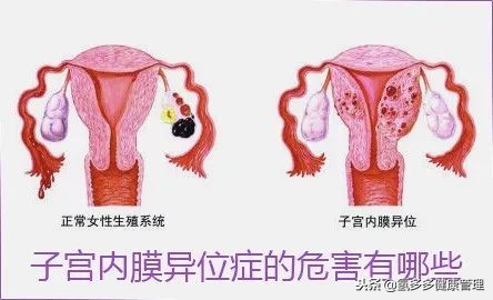 第二军医大学附属长海医院:氢气治疗子宫内膜异位症