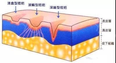 激光祛痘印是永久祛痘印的吗,目前最有效祛痘印祛痘坑的方法