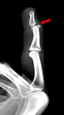 怎样发现骨折的可能性,一招看出手指骨折