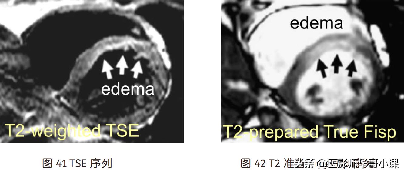 磁共振心脏扫描标准切面,心脏mri扫描定位