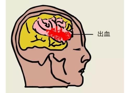 脑卒中超早期康复科普,1分钟了解脑梗