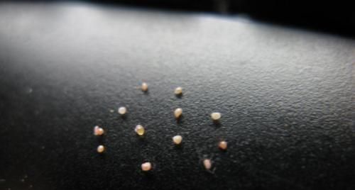 挤眼角脂肪粒的过程,眼角脂肪粒怎么去除最简单方法