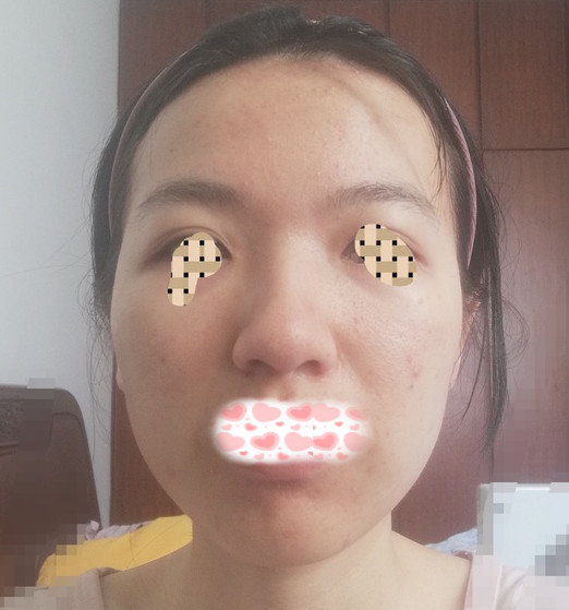 面部微调脸型,如何改善脸型整形