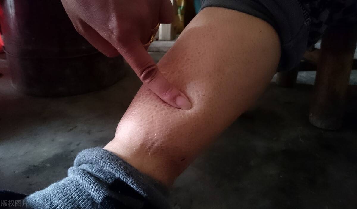 中年男性，浮肿、大量蛋白尿，突发胸闷是怎么回事？