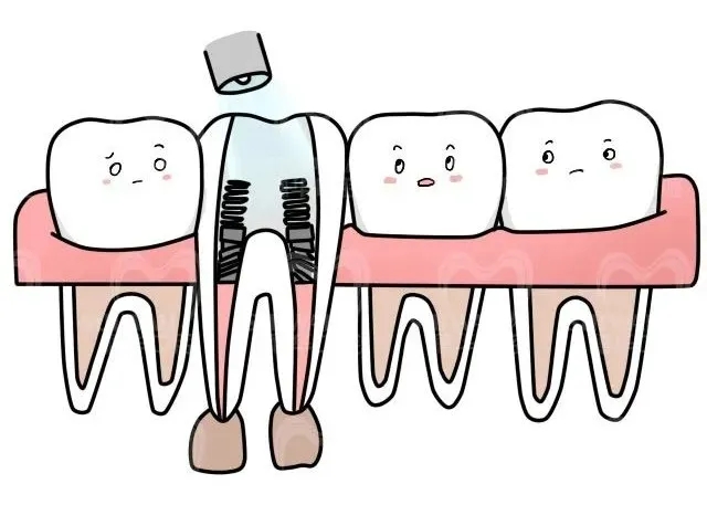 根管治疗后不做牙冠会怎样?