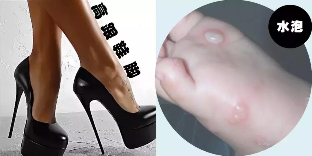 脚拇外翻怎么办教你一招,你的脚好丑的意思