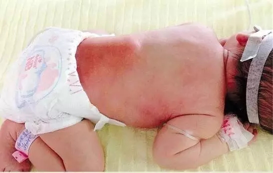 宝宝满身脓包,竟然是因为这个!快看看你家有没有,四招轻松搞定