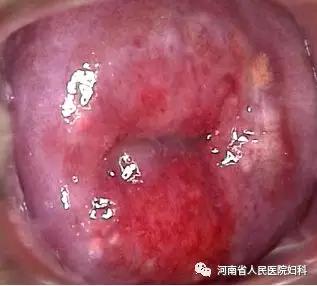 你知道什么是宫颈糜烂吗？