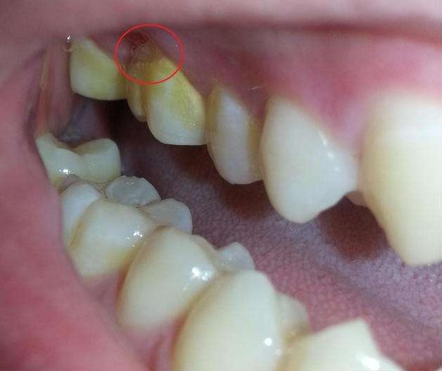 不洗牙去除牙结石的实用方法,牙结石特别严重如何洗牙