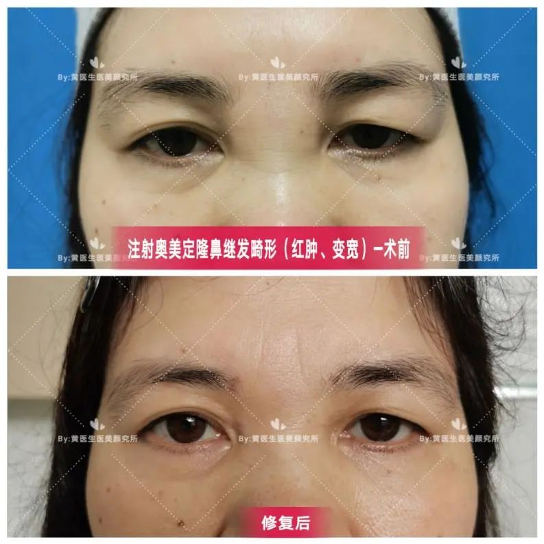 隆鼻材料你真的选对了吗,隆鼻哪种材料好你真的足够了解吗