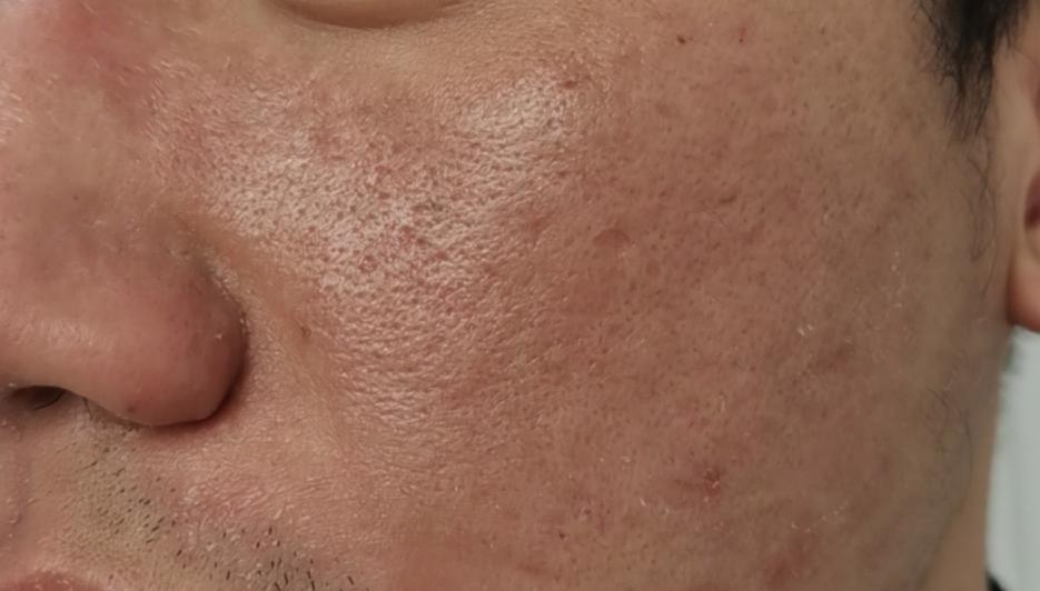 各个年龄段的皮肤问题,困扰年轻人的三大皮肤问题