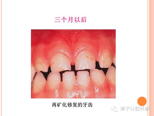 蛀牙治疗科普,蛀牙安全有效的方法