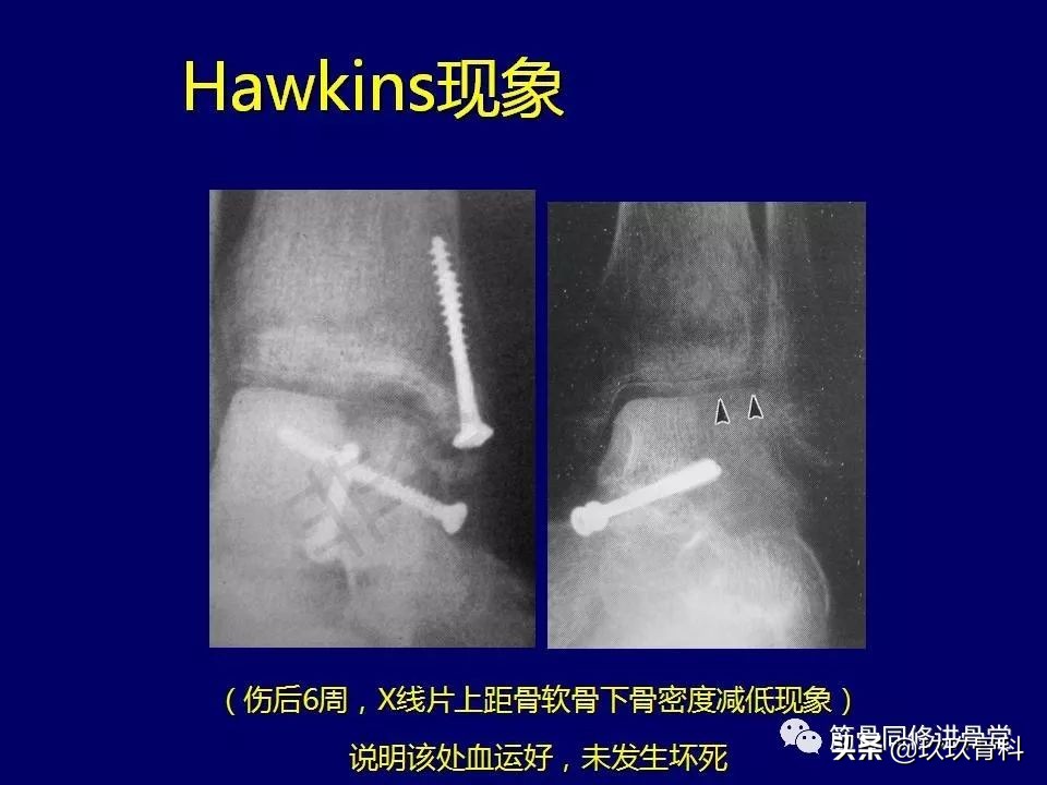 距骨骨折的治疗原则,距骨骨折如何调理