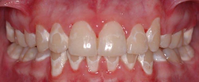 牙齿长白斑怎么消除,牙齿上长白斑什么原因