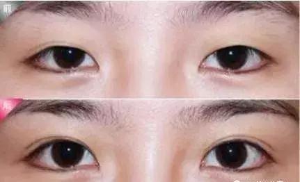 割双眼皮内外眼角都开,做双眼皮开外眼角会回缩吗