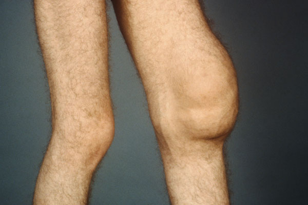 膝关节疼痛氨糖买什么牌子好,膝盖疼买氨糖怎么选