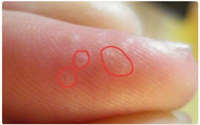 一到夏天,手上就长小水疱?汗疱疹别挑破,艾灸止痒防复发