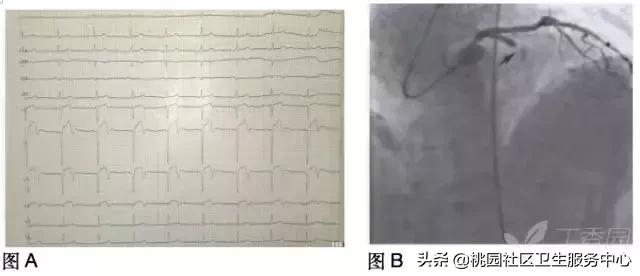 早期心梗心电图能查出来吗,警惕这种要命的心电图表现