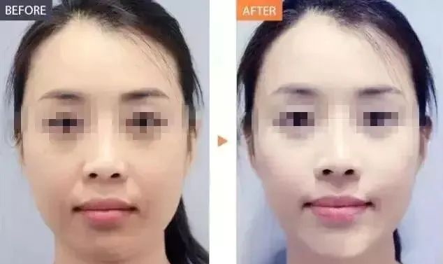 哪种果酸治闭口最好用,什么果酸对闭口有用