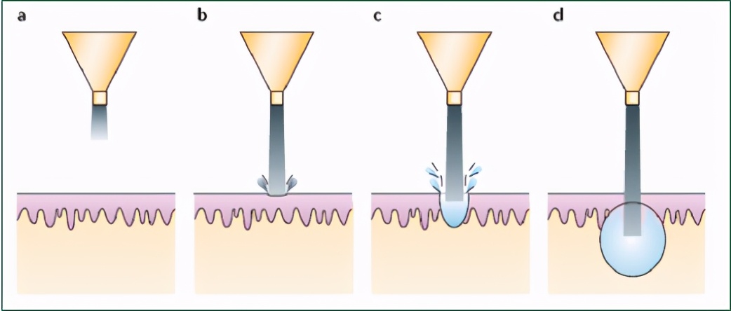 「掌健识」可恶的瘢痕疙瘩，你知道怎么去掉吗？