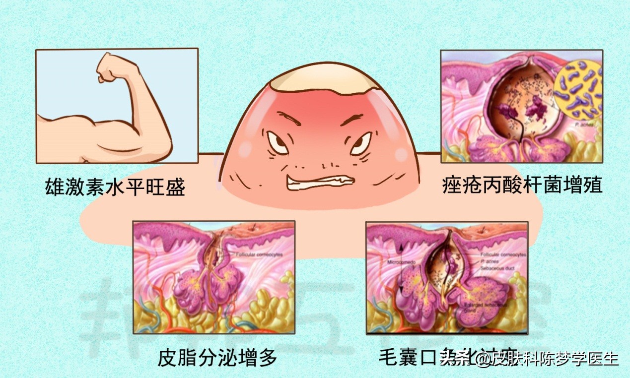 碘伏治疗痘痘,碘伏治疗痘痘好方法