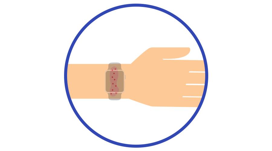 佩戴applewatch过敏能退吗,applewatch戴着皮肤过敏