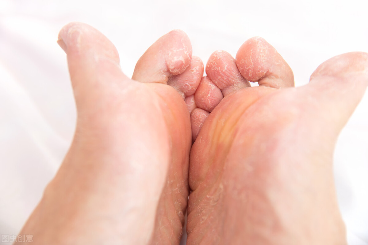 脚气到底怎么治呢,如何才能摆脱脚气的困扰