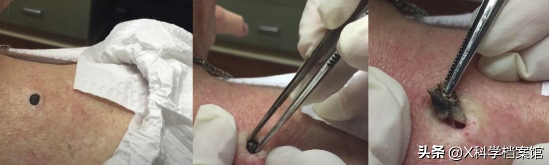 疯了!挤黑头视频7000万人看,为什么网友一边直呼恶心一边追着看