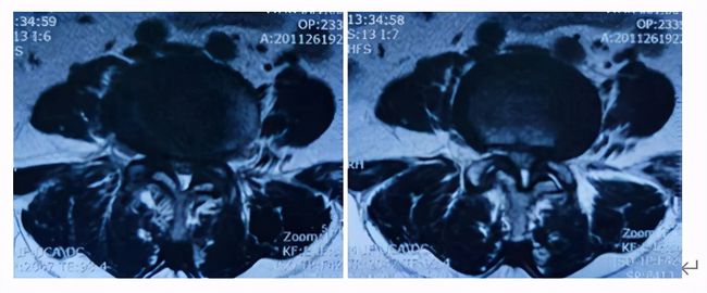 腰椎管狭窄有滑脱能做微创吗,腰椎滑脱椎管狭窄可做微创吗