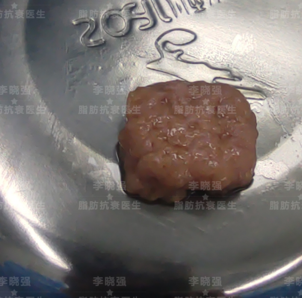 面部精雕收颧骨手法,颧骨高太阳穴凹陷怎么整形