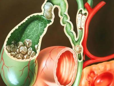 肝移植患者得了胆管癌,亲人得了胆管癌该怎么办