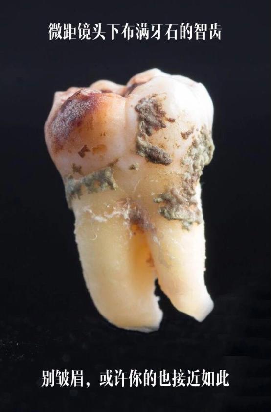 洗牙牙齿问题,医院口腔科洗牙和外面洗牙区别