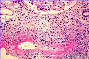 常见的肺间质疾病,常见血管疾病