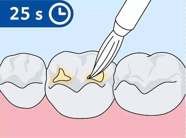 什么是儿童窝沟封闭？会不会痛？1分钟视频带你看懂#雅悦齿科#