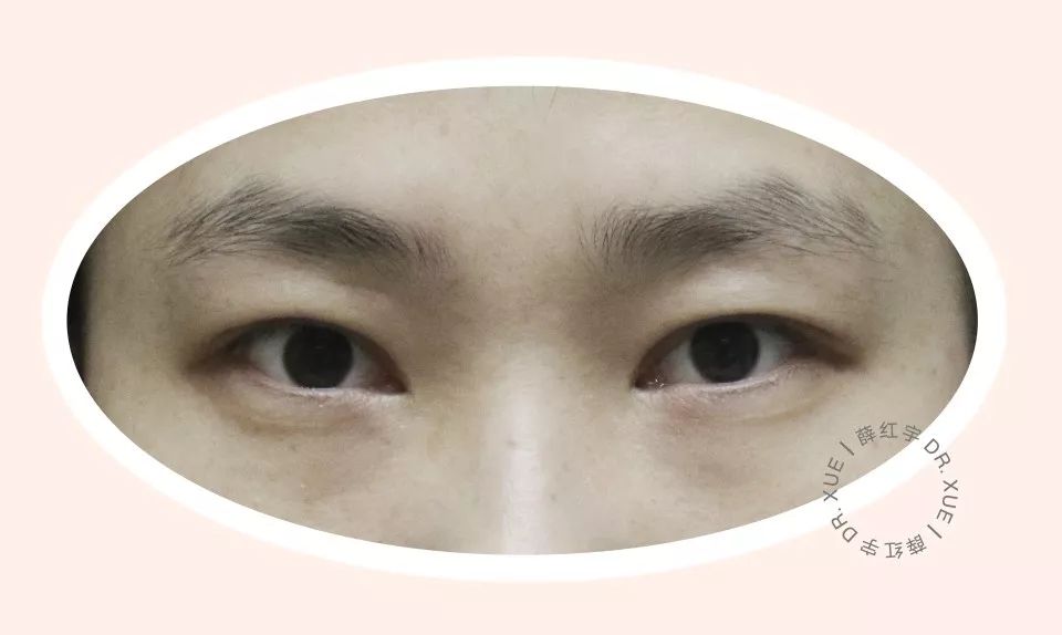 要不要开下眼睑,要不要开内眦赘皮