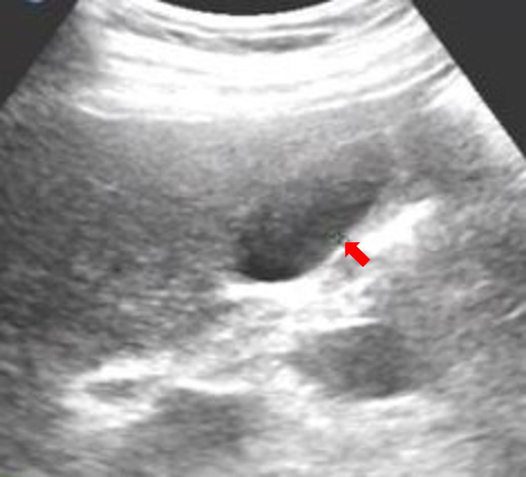 空腹做彩超能检查出什么,彩超为什么检查肝要空腹