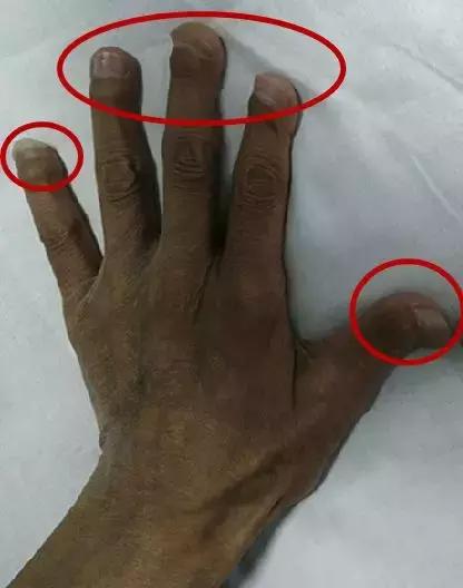 慢性肾病透析后肾还能恢复吗,慢性肾功能衰竭尿毒症透析