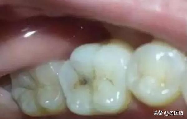 牙齿吃雪糕敏感怎么办,牙齿吃冰的就特别敏感怎么办