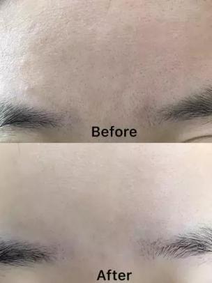 喷雾式的去黑头的东西,去黑头收缩毛孔吸黑头神器测评