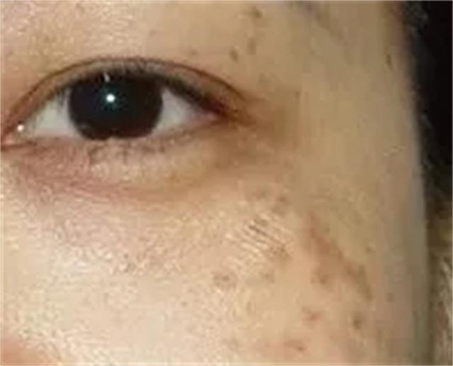 常见的色斑种类图文,脸部常见斑种类及图片