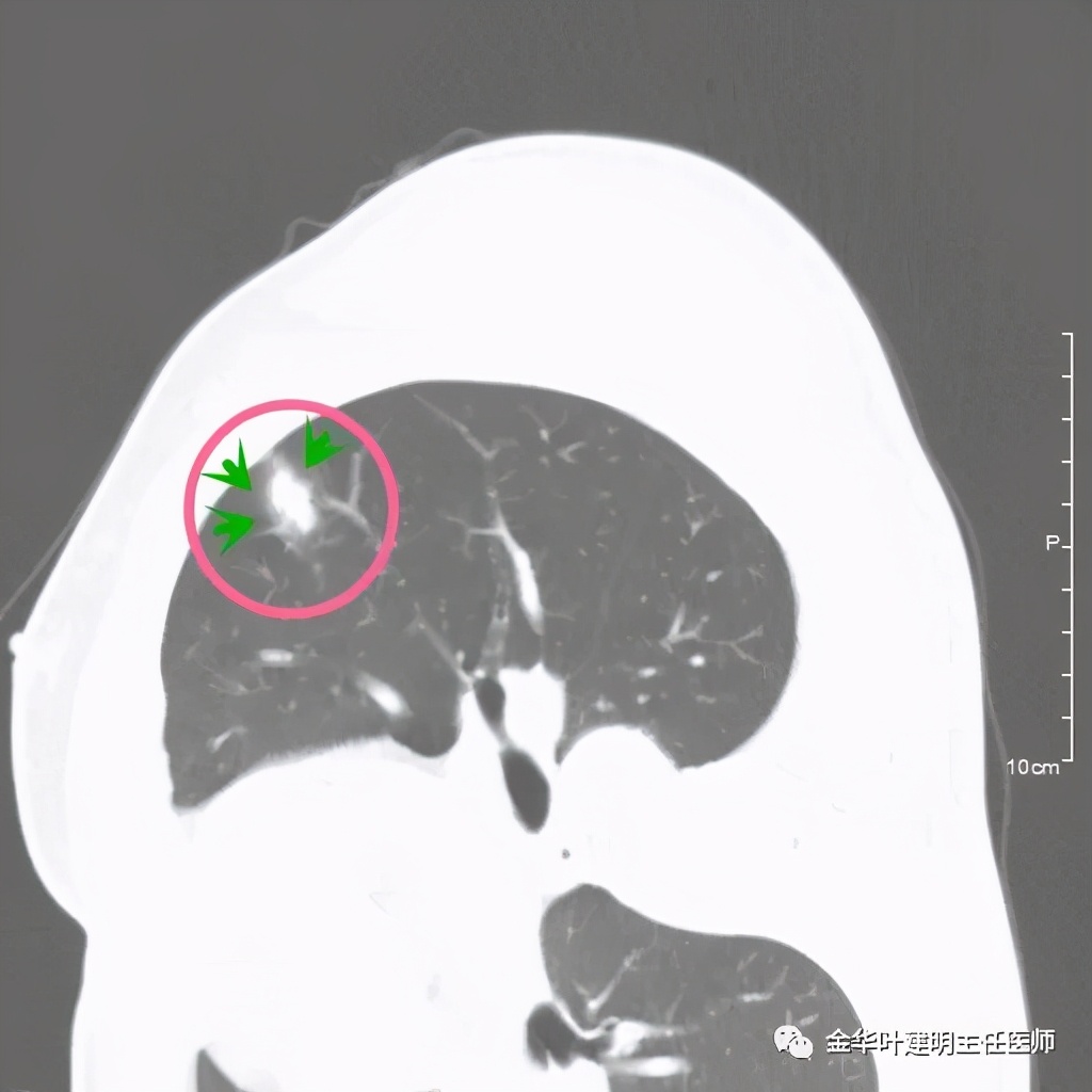 叶建明谈肺结节:一招分辨隐球菌性肉芽肿与肺癌