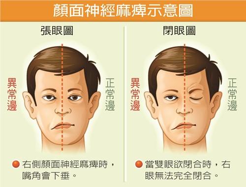 对着空调吹一晚致面瘫,夏天吹空调面瘫