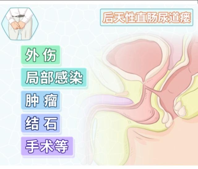 直肠尿道瘘轻的症状,尿道直肠瘘会死人吗