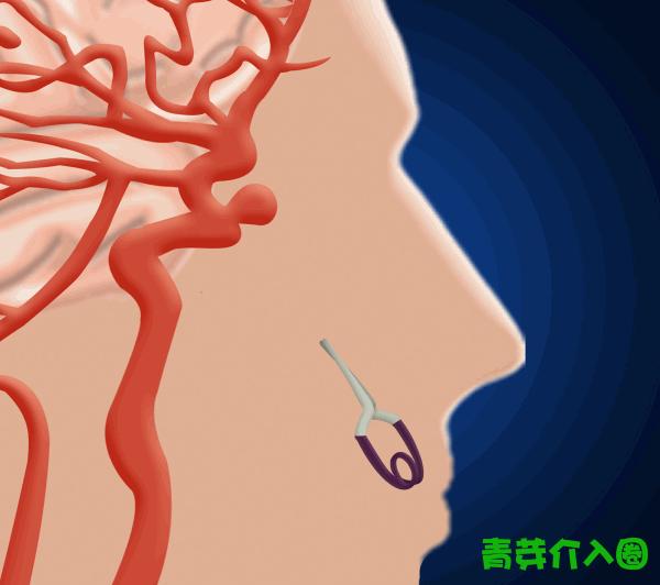 颅内动脉瘤介入栓塞支架全过程,颅内夹层动脉瘤介入演示