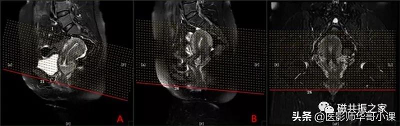 「精品课件」带大家看看，磁共振子宫MRI要如何扫描？