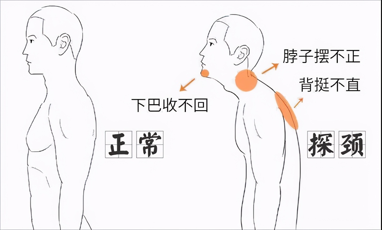 太极拳治颈椎病最好的方法,太极拳可以治疗颈椎病吗